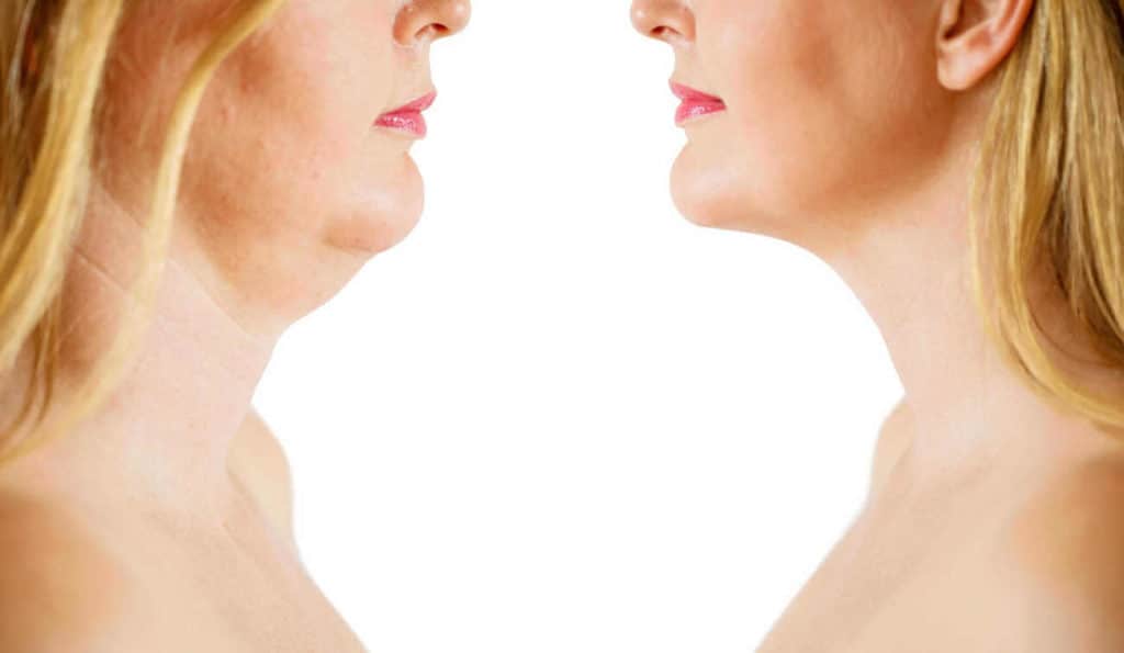 Double Chin treatment Kensington and Chelsea before and after results