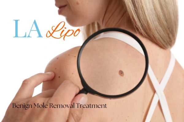 Woman having her inspection of blemish before mole removal Kensington and Chelsea