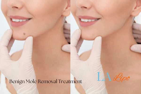 Before and after mole removal Kensington and Chelsea treatment