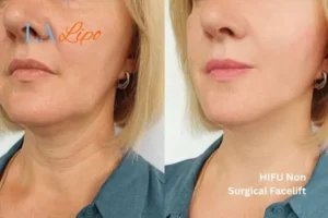 hi-fu for wrinkles Kensington and Chelsea before and after results