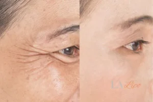 Before and after results of woman - HI-fu wrinkles reduction treatment Kensington and Chelsea