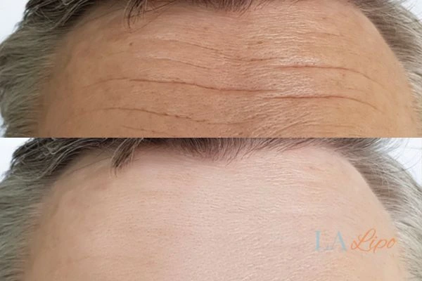 results of HIFU Kensington and Chelsea on mans forehead to help reduce lines and wrinkles