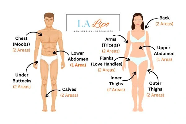 LA LIPO Cryolipolysis Areas Kensington and Chelsea