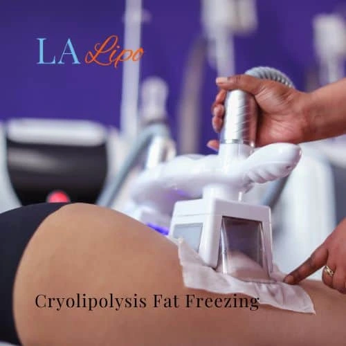 fat freezing - Cryolipolysis Kensington and Chelsea