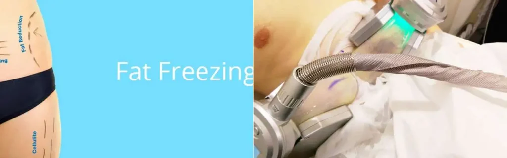multi areas of a persons body having coolsculpting Kensington and Chelsea treatment