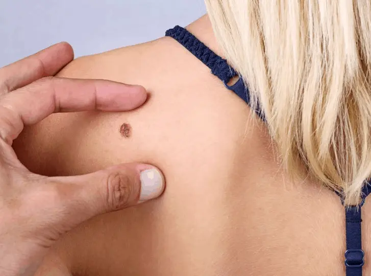 woman having mole removal Kensington and Chelsea consultation before treatment.