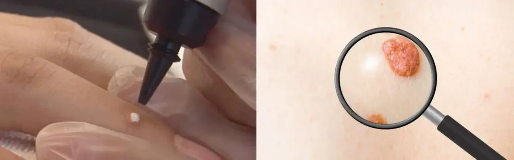 Cryopen for mole removal Kensington and Chelsea - speak to our team today!