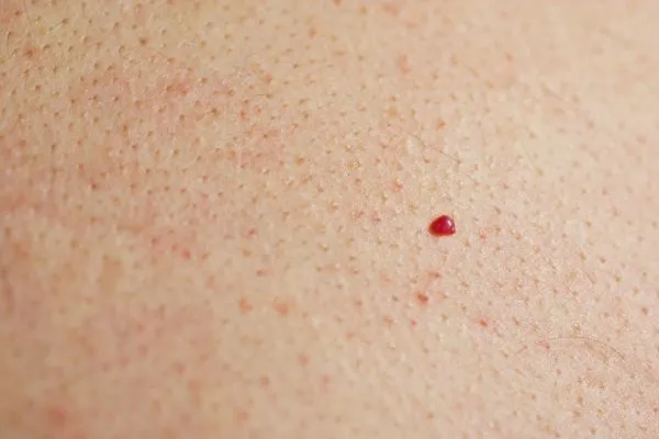 close up of a cherry angioma Kensington and Chelsea