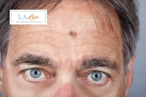 Solar Lentigo Removal Kensington and Chelsea image of man with mark on his forehead