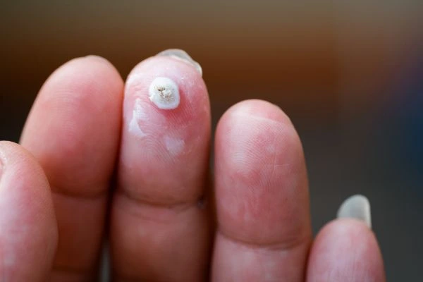 wart on person finger - cryotherapy to treat from LA LIPO Kensington and Chelsea