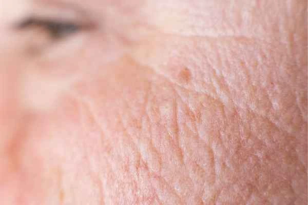 close up picture of a woman's face showing an age spot Kensington and Chelsea