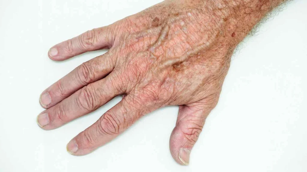 Male hand showing age spot Kensington and Chelsea